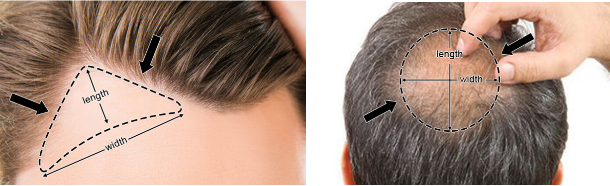 crown hair loss